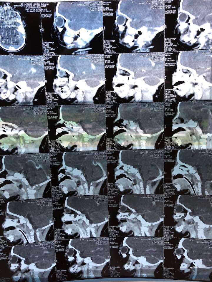 Hình CT scan mũi : khối u xuất phát từ cuốn mũi giữa, thòng xuống họng