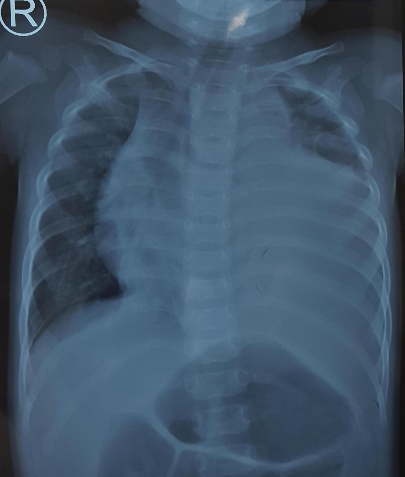 Tràn dịch màng phổi trái lượng nhiều gây chèn ép phổi, đẩy lệch tim và khí quản