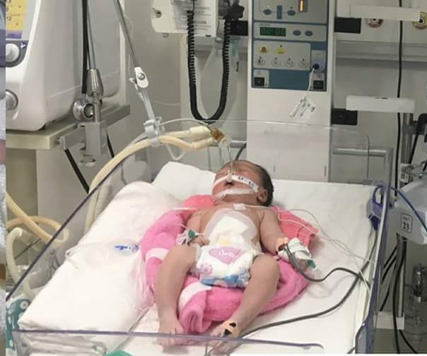 Trẻ thoát rị rốn to được phẫu thuật đóng thành bụng thành công trước 3 giờ tuổi