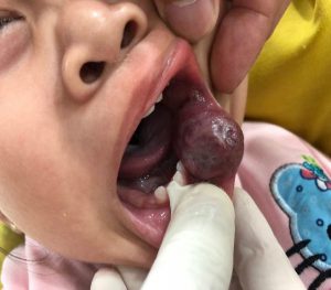 Hình ảnh trước khi mổ: Bệnh nhân nữ, 20 tháng, bị u máu vùng miệng lớn