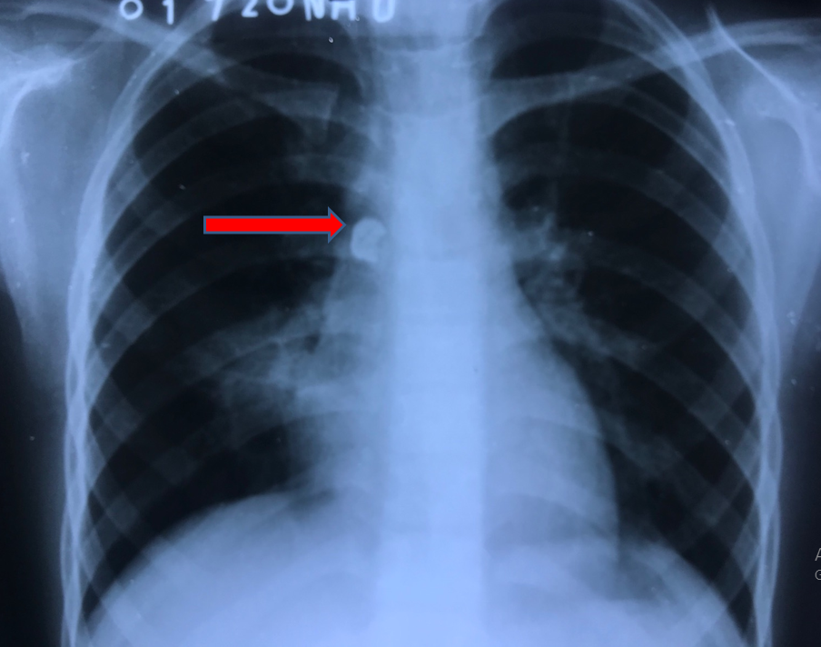 Hình ảnh Xquang phổi cho thấy dị vật nằm bên phải cạnh cột sống