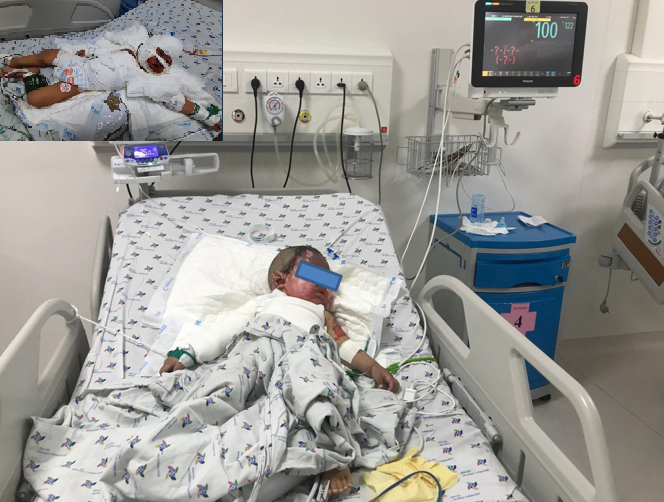 Trẻ  được chuyển khoa hồi sức ngoại điều trị tiếp