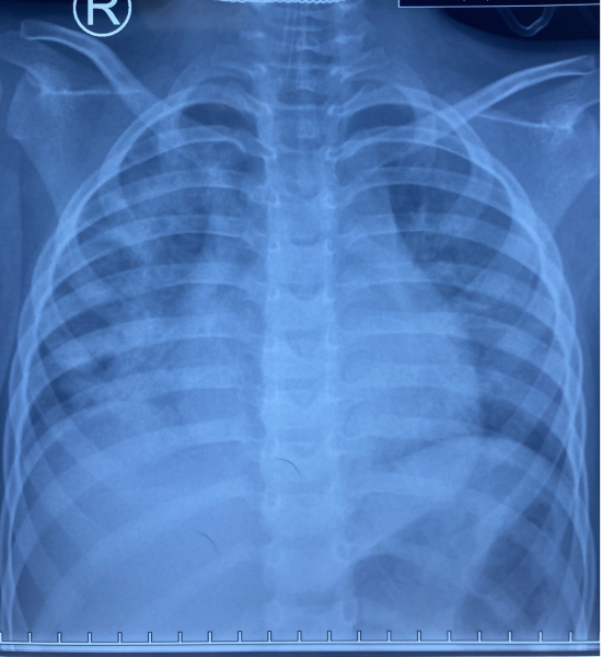 Xquang ngực cho thấy tổn thương phổi lan tỏa 2 phế trường