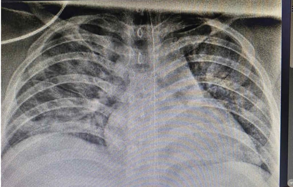 Xquang ngực cho thấy hình ảnh tổn thương thâm nhiễm phổi nặng lan tỏa 2 phế trường.
