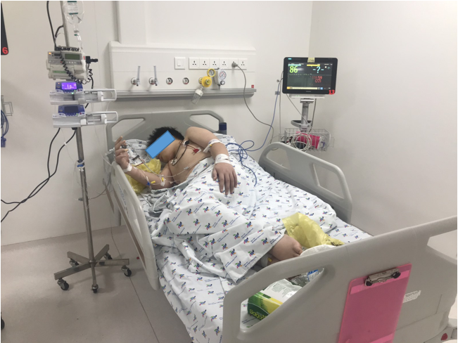 Trẻ H. P. S. 14 tuổi, nam, sốc mất máu do xuất huyết tiêu hóa, viêm loét dạ dày tá tràng, được hồi sức tích cực, nội soi cấp cứu cấp cầm máu ổ loét hành tá tràng.