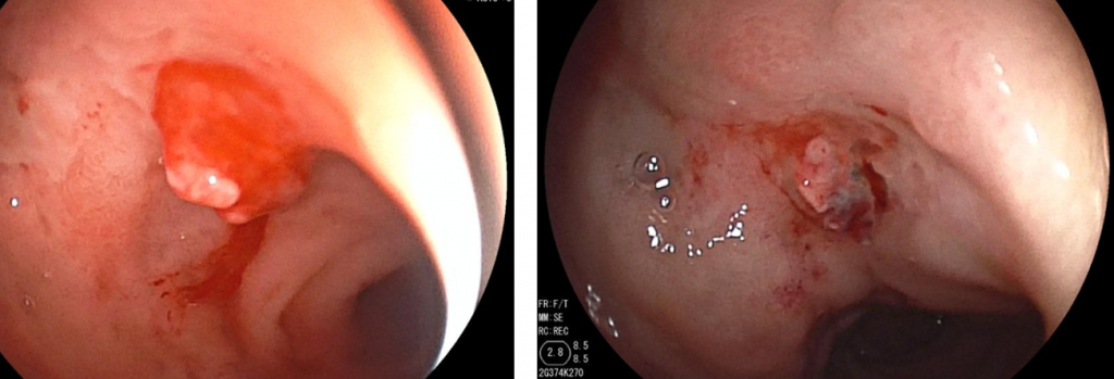 Hình ảnh nội soi đường tiêu hóa cho thấy ổ loét chảy máu ở tá tràng, và ngưng chảy máu sau khi chích xơ.