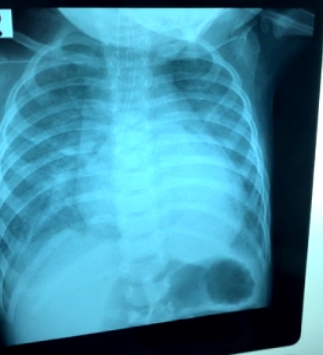 Xquang ngực cho thấy tổn thương phổi lan tỏa 2 phế trường, bóng tim to