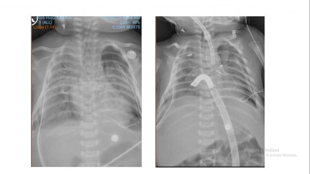 Hình ảnh tổn thương phổi trước chạy ECMO cải thiện dần trong lúc chạy ECMO