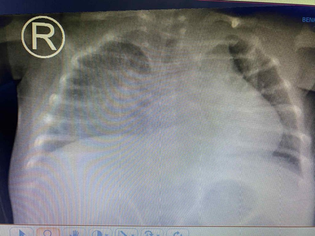 Xquang ngực cho thấy hình ảnh tổn thương thâm nhiễm phổi nặng lan tỏa 2 phế trường.
