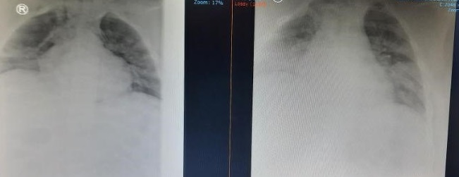 Xquang ngực cho thấy hình ảnh tổn thương thâm nhiễm phổi nặng lan tỏa 2 phế trường chỉ sau 24 giờ so với tổn thương phổi ban đầu.