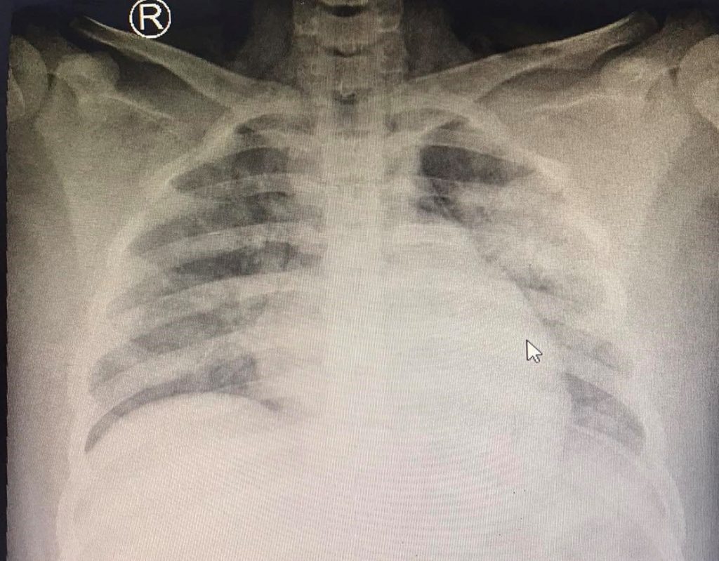 Xquang ngực cho thấy hình ảnh tổn thương thâm nhiễm phổi nặng lan tỏa 2 phế trường