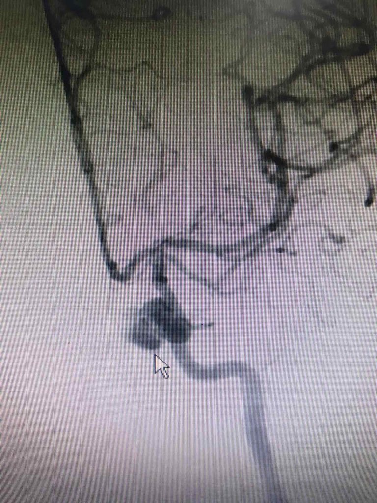 Digital angiography with background erasure shows a left internal carotid aneurysm.