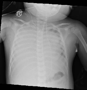 Chest X-ray showed the child had collapsed lung and hemothorax
