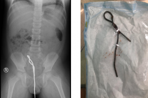Hình ảnh Xquang bụng không sửa soạn cho thấy thanh sắt trong đường tiêu hóa dưới và được các bác sĩ ngoại khoa lấy ra
