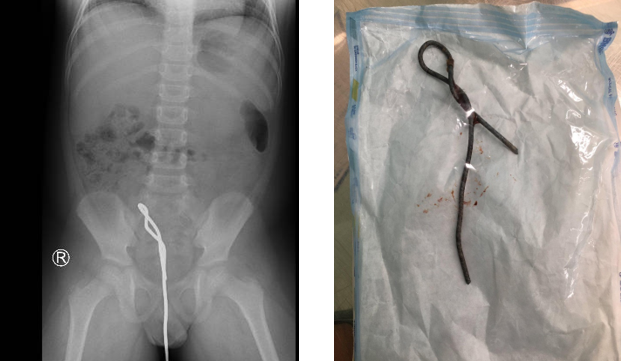 Hình ảnh Xquang bụng không sửa soạn cho thấy thanh sắt trong đường tiêu hóa dưới và được các bác sĩ ngoại khoa lấy ra