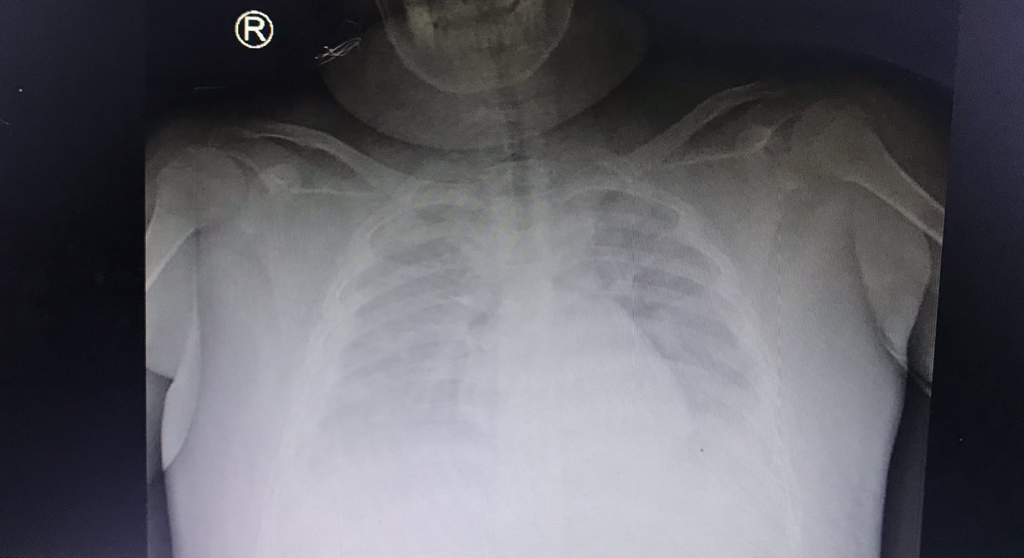 Xquang phổi cho thấy trẻ bị tràn dịch màng phổi và tổn thương phổ 2 bên