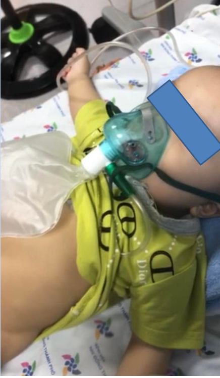 Trẻ Ph. T. T. D. 5,5 tháng  tuổi, nam, viêm thanh quản cấp, suy hô hấp nặng được điều trị tích cực thở oxy qua mask có túi dự trữ, khí dung thuốc chống phù nề đường thở, chống viêm