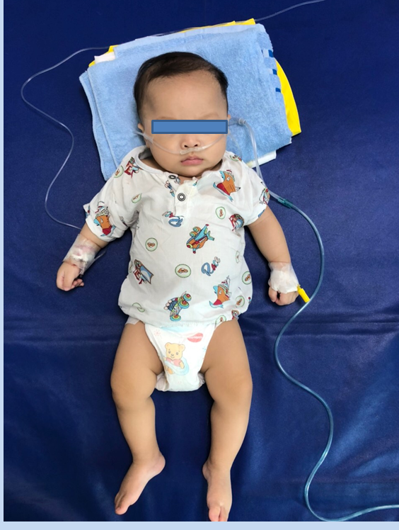 Sau 24 giờ điều trị tình trạng trẻ cải thiện dần, tỉnh táo, hồng hào, được tiếp tục điều trị tại khoa Nhiễm