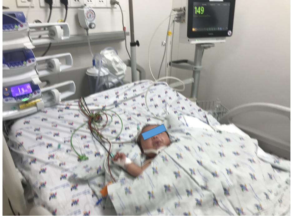 After more than 2 weeks of treatment, the child's condition gradually improved forearm (T) with less swelling, good perfusion, rosy skin, clear radial pulse, weaned breathing, good feeding.