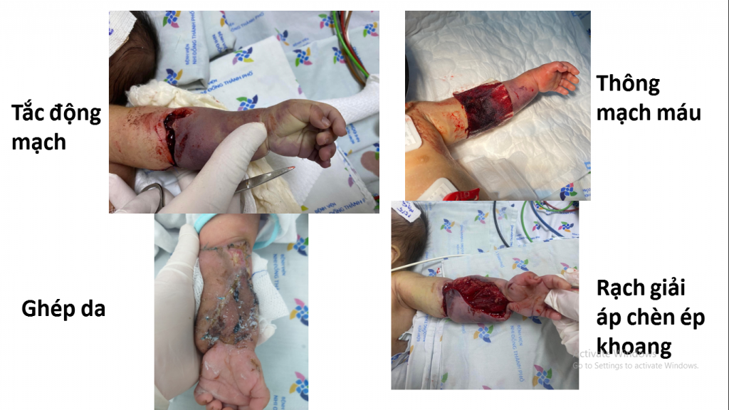 The left forearm that was thought to be amputated was vascularized, decompressed the cavity, mixed with anticoagulants, restored skin grafts