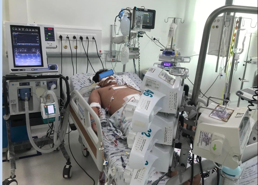 Young Tr.  M. Kh.  14 years old, male, weight 72 kg, overweight, severe dengue shock, anti-shock, invasive mechanical ventilation, peritoneal drainage.