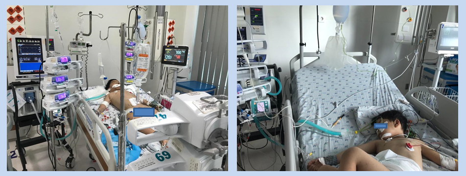 Children with NKBM, 5 years old, male, weighing 20 kg, severe dengue shock, receiving anti-shock, invasive mechanical ventilation, peritoneal drainage.