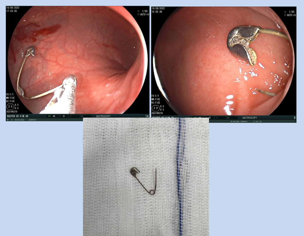The gastrointestinal foreign body is a needle, which is endoscopically removed and removed