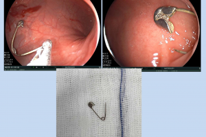 Dị vật đường tiêu hóa là cây kim băng, được nội soi và gắp ra