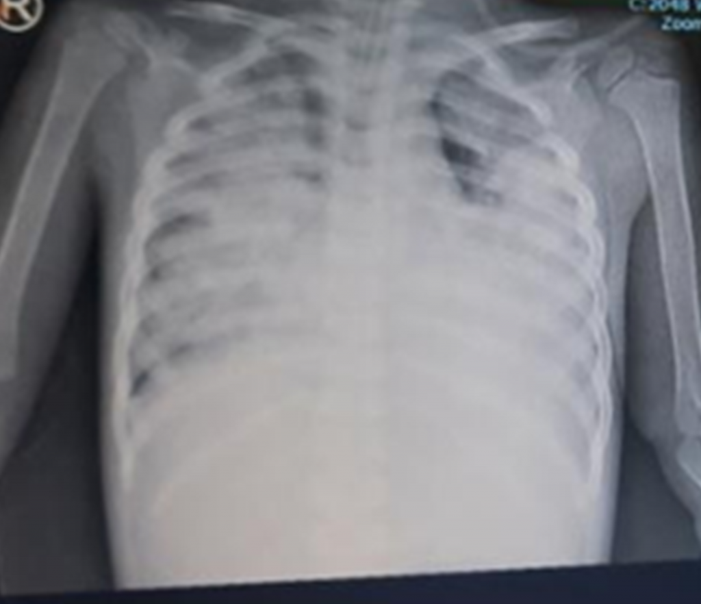 Chest x-ray showed diffuse pulmonary infiltrates in 2 lung fields.