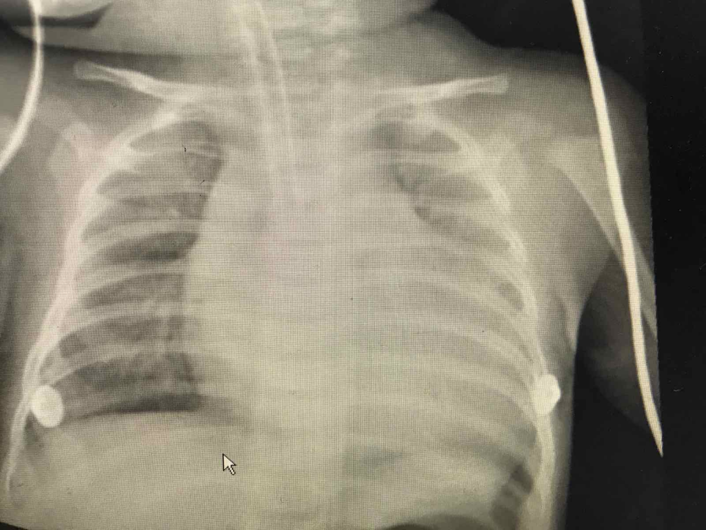   Chest X-ray shows a very large heart shadow