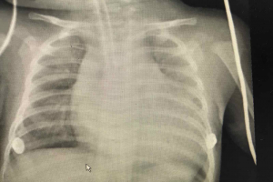 Xquang ngực cho thấy bóng tim rất to