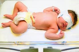 Trẻ sơ sinh vàng da (hình ảnh trên Internet)