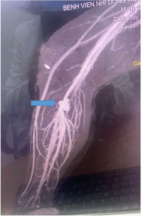 Hình ảnh CTA cho thấy túi phình mạch máu lớn, gây cản trở tưới máu chi