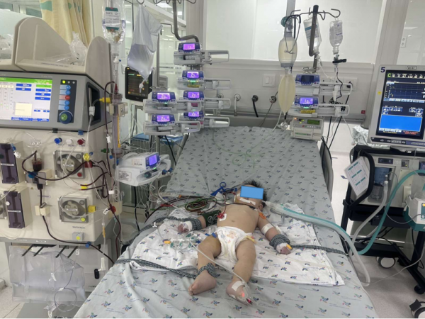 Trẻ Ng. G. L. 8 tháng, nam, chẩn đoán bệnh tay chân miệng độ 4, được điều trị tích cực thở máy, lọc máu liên tục, truyền IVIG, milrinone.