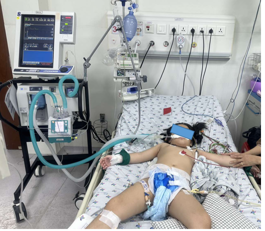 Trẻ Ng. N. H. M. 6 tuổi, nữ, chẩn đoán bệnh tay chân miệng độ 3, được điều trị tích cực thở, chống co giật, chống phù não, truyền thuốc điều hòa miễn dịch gammaglobuline, milrinone, an thần midazolam, hạ sốt.