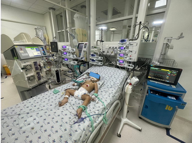 Ng. T. Đ. 17 tháng, nam chẩn đoán bệnh tay chân miệng độ 4, được điều trị tích cực thở máy, lọc máu liên tục, truyền IVIG, milrinone.