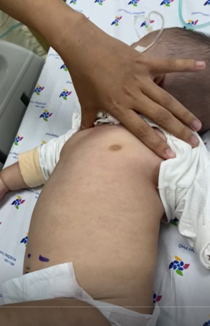 Trẻ H. D. T. 5 tháng tuổi, nam, ngụ ở Bình Thuận, chẩn đoán sốc sốt xuất huyết nặng, rối loạn đông máu, được điều trị truyền dịch chống sốc, truyền máu, huyết tương, tiểu cầu.