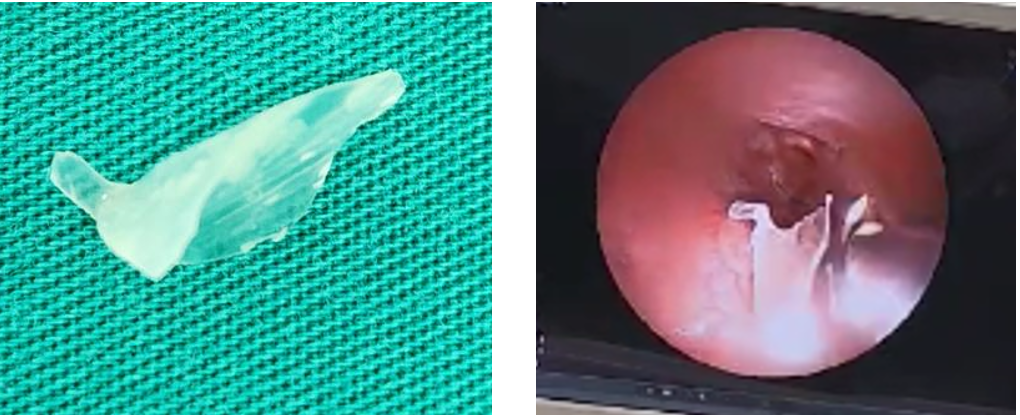 Hình ảnh nội soi đường thở gắp ra mảnh xương cá hình tam giác từ vùng hạ thanh môn của trẻ