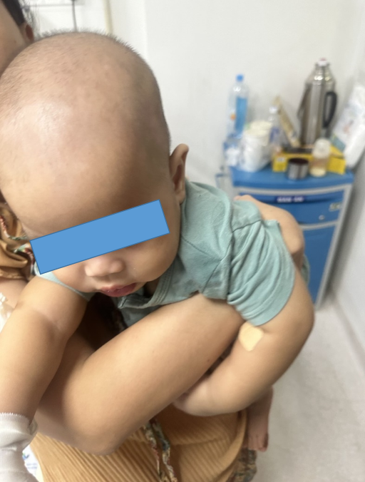 Hình ảnh nội soi đường thở gắp ra mảnh xương cá hình tam giác từ vùng hạ thanh môn của trẻ