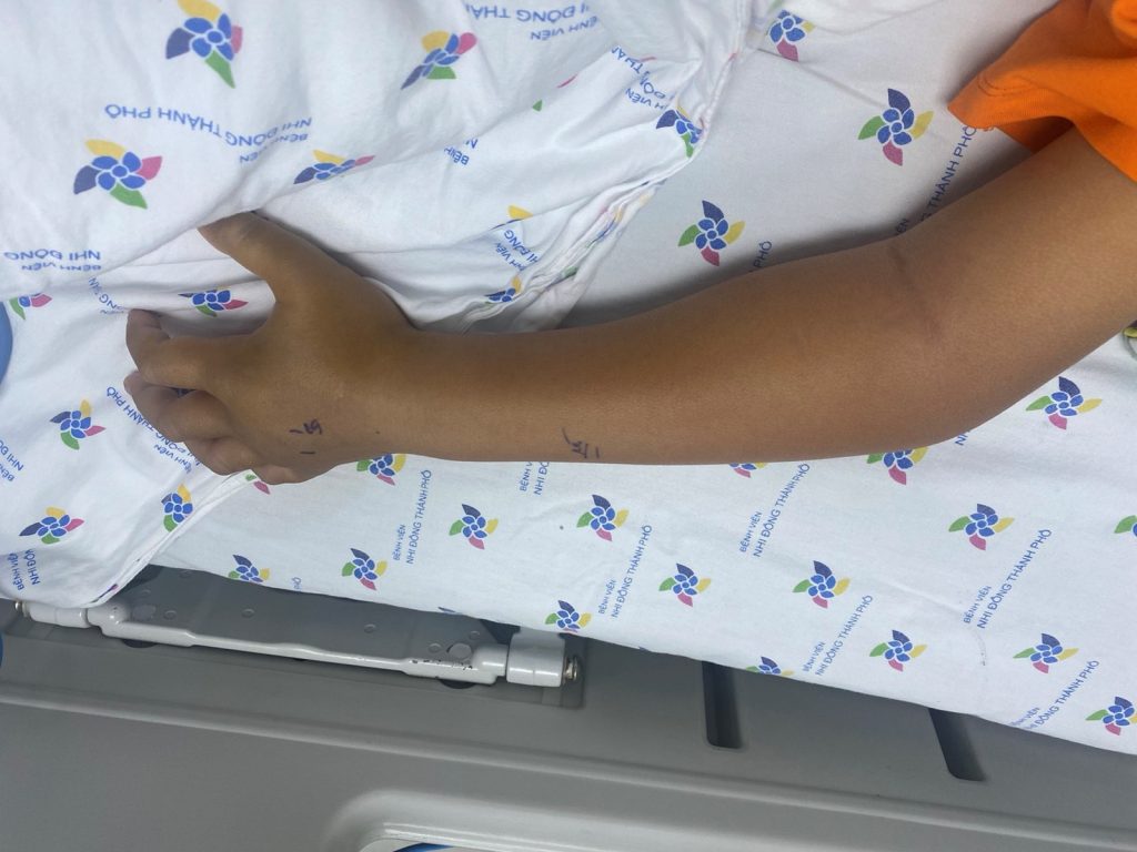 Trẻ Tr. Q. Đ 8 tuổi, nam bị rắn cắn ở bàn tay trái, gây sưng nề chảy máu, được truyền huyết thanh kháng nọc rắn đặc hiệu