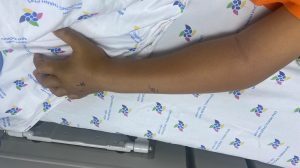 Trẻ Tr. Q. Đ 8 tuổi, nam bị rắn cắn ở bàn tay trái, gây sưng nề chảy máu, được truyền huyết thanh kháng nọc rắn đặc hiệu