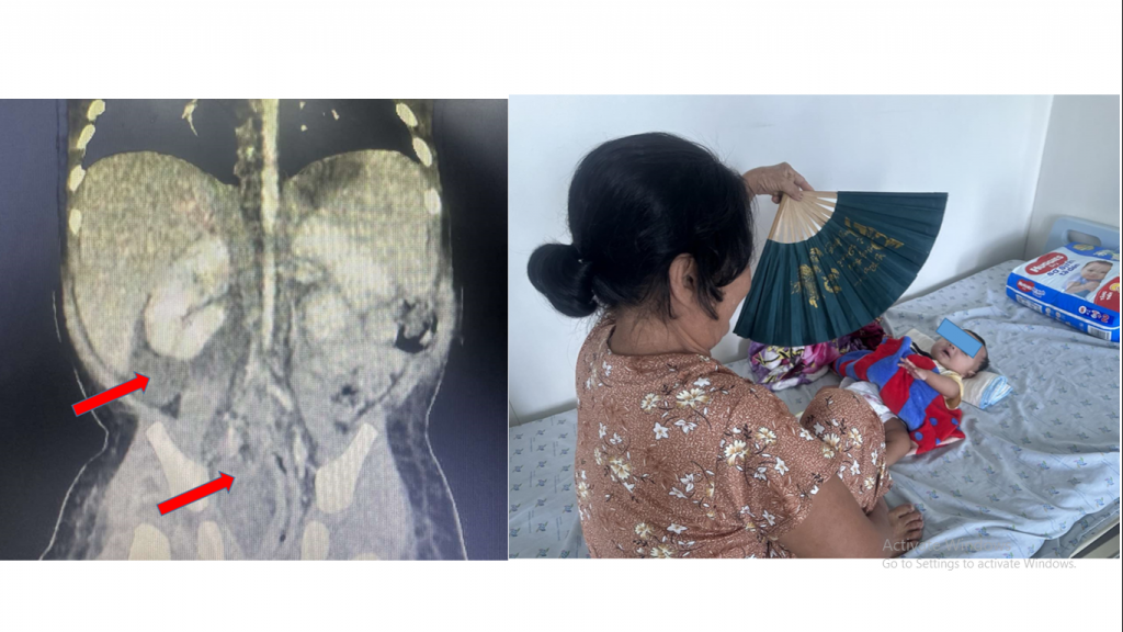 Trẻ Tr. V. Kh. 4 tháng tuổi, nam, chẩn đoán: nhiễm trùng huyết tử ổ mủ sâu sau phúc mạc ổ bụng (mũi tên đỏ trên CT scan bụng), được điều trị tích cực với kháng sinh, mổ dẫn lưu ổ mủ.