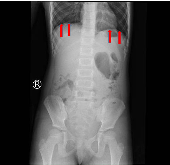X-quang bụng đứng không sửa soạn cho thấy liềm hơi dưới cơ hoành, gợi ý thủng tạng rỗng