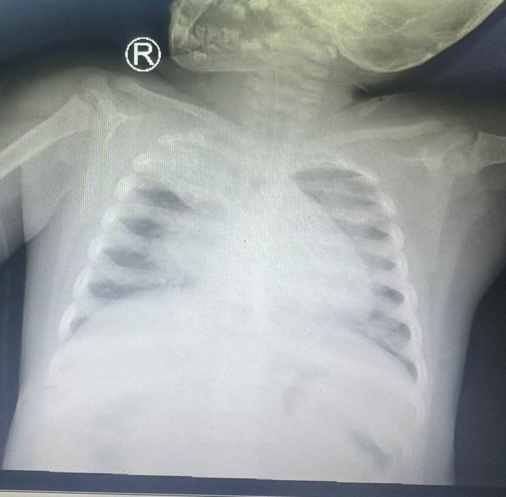 Xquang phổi: tổn thương lan tỏa 2 bên phổi, xẹp đỉnh phổi (P).