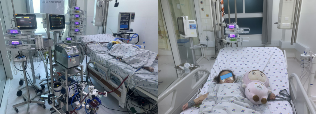 Trẻ  N. N. H. A. 3 tuổi, chẩn đoán: viêm phổi nặng – ARDS nặng do cúm A/H1 pdm 2009, được điều trị tích cực, thở máy, ECMO, kháng sinh, kháng virus, trẻ cải thiện phục hồi sức khỏe.