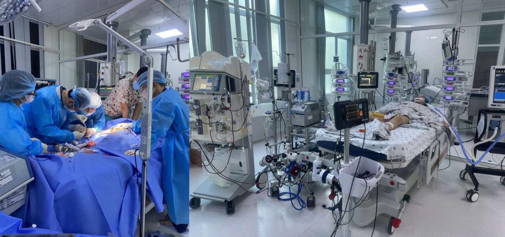 Trẻ Tr. L. T. Ng. 13 tuổi, nữ,  chẩn đoán: Sốc tim/ viêm cơ tim tối cấp rối loạn nhịp tim, vừa cấp cứu ấn tim thở máy vừa thực hiện ECMO, sau đó hỗ trợ thêm lọc máu liên tục.