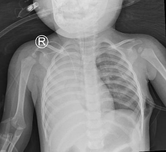 Xquang phổi trước nội soi xẹp toàn bộ phổi phải