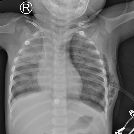 Xquang phổi sau nội soi: viêm phổi 2 bên