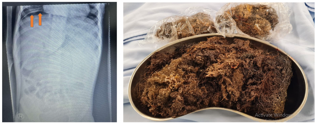 Xquang bụng đứng không sửa soạn ghi nhận liềm hơi dưới cơ hoành, búi xơ sơi được mổ lấy ra khỏi dạ dày