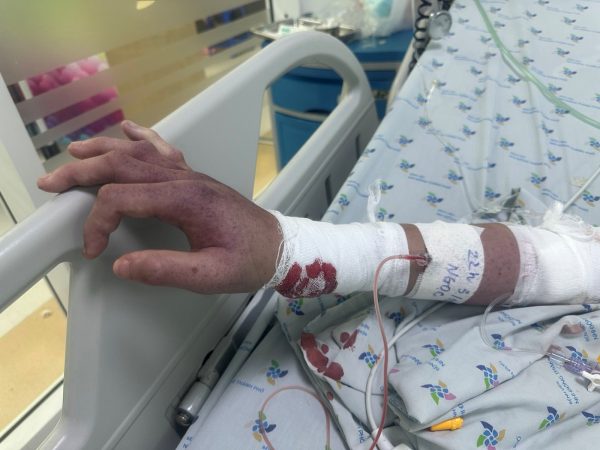 Cứu sống một trường hợp trẻ sốc sốt xuất huyết rối loạn đông máu nặng